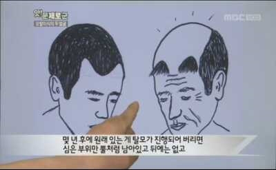 M자탈모되기